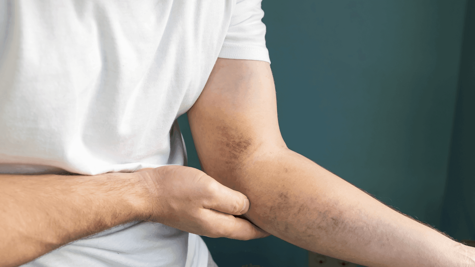 bruise on elbow